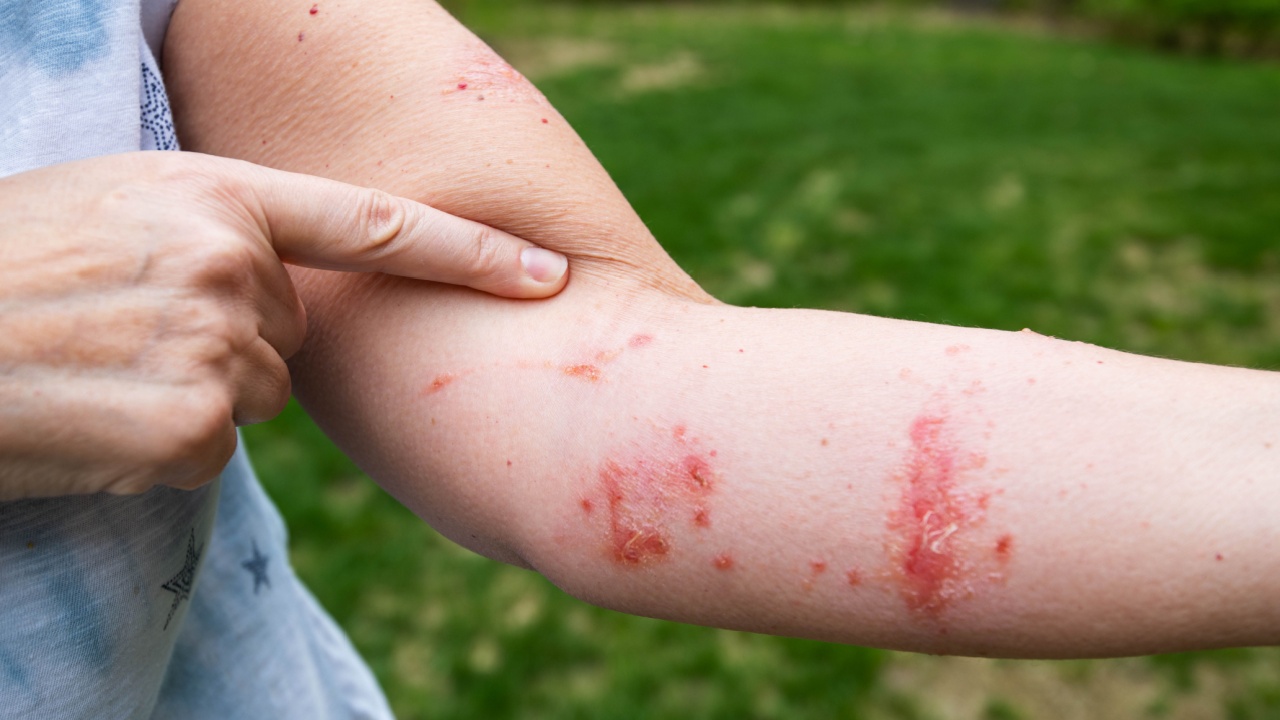 Pointing at itchy poison ivy / poison oak rash and infection with blisters and oozing