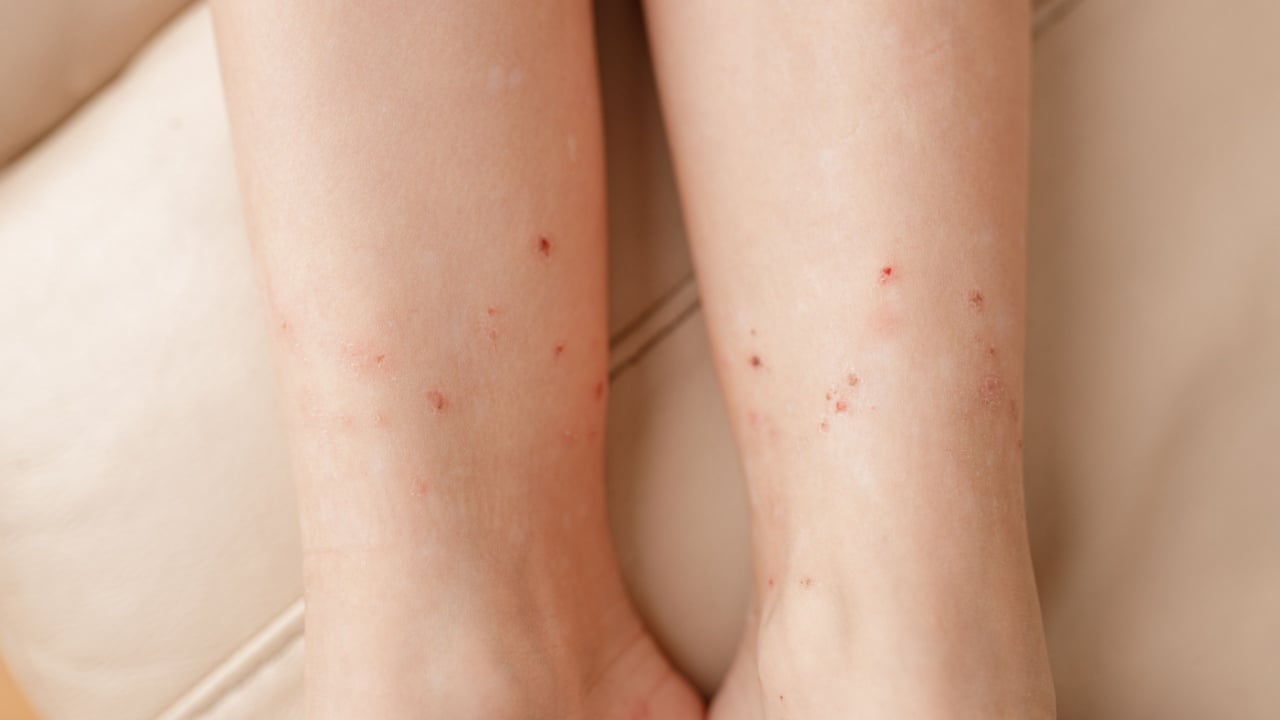 Child's legs with many red spot, from insect bite, mosquitos and fleas.